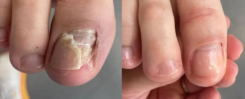3. Nail Reduction and Reconstruction